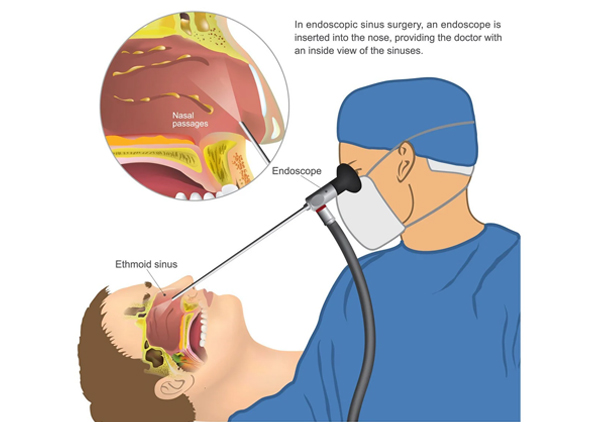 endoscopic-ear